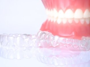 Teeth Straightening Aligners, Clear Teeth Straighteners
