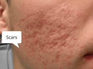 How to remove acne scars fast | ayurvidha