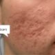 How to remove acne scars fast | ayurvidha