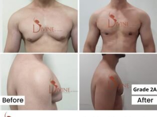 How does Life Stop because of Gynecomastia?
