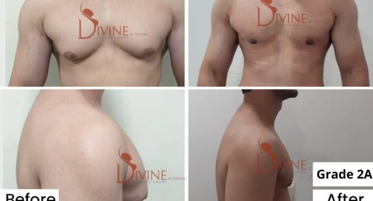How does Life Stop because of Gynecomastia?