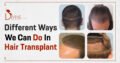 Different Ways we can do in Hair Transplant